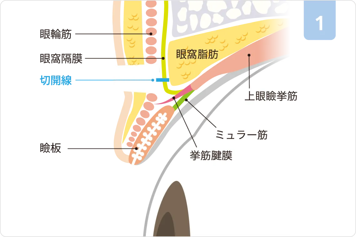 挙筋前転術ステップ1：切開線