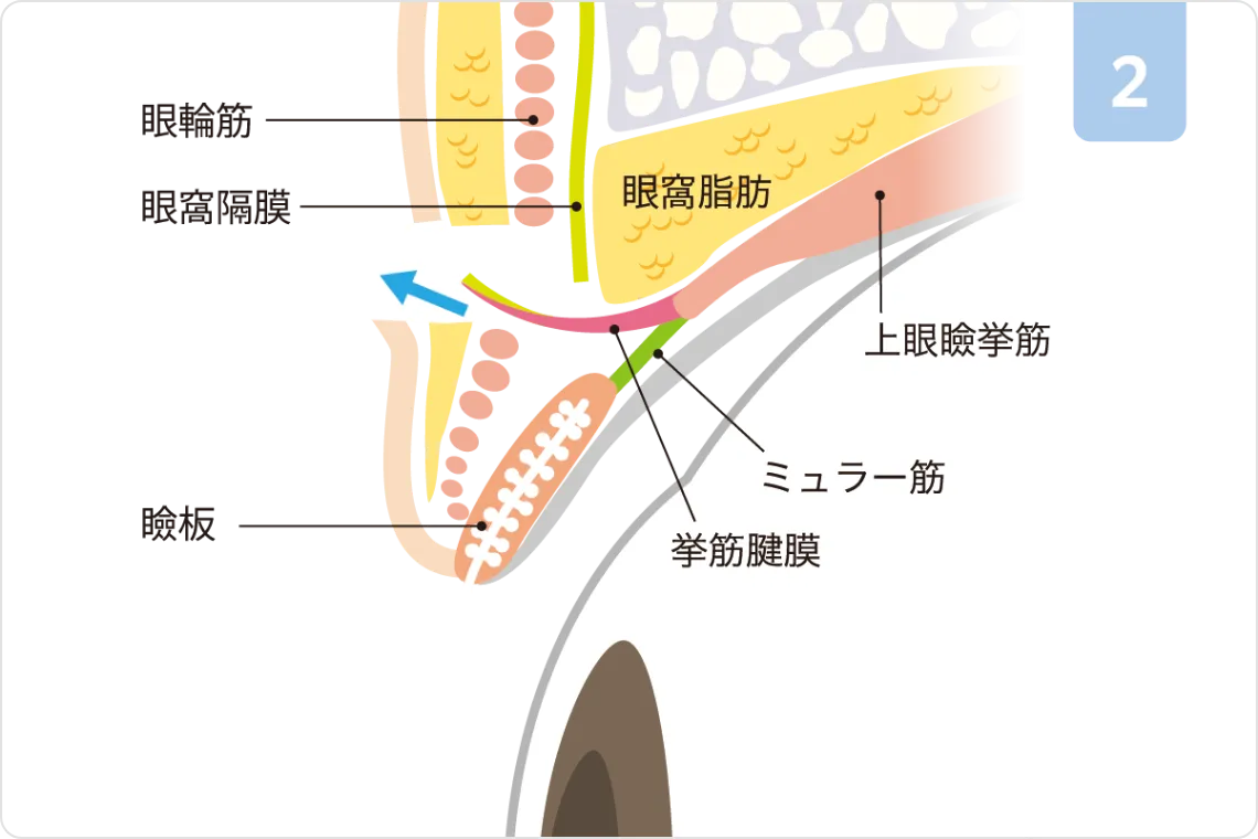 挙筋前転術ステップ2：腱膜の引き出し