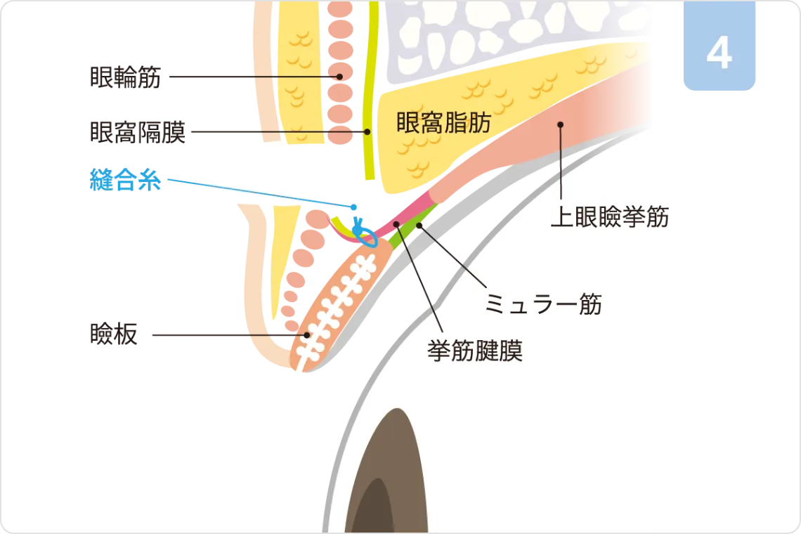 挙筋前転術ステップ4：腱膜の固定