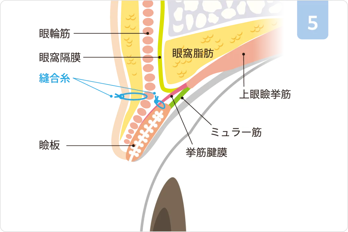 挙筋前転術ステップ5：縫合完了